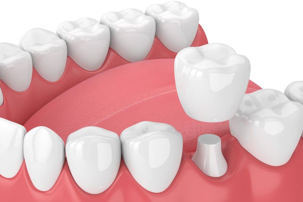 Understanding the Cost of Dental Crowns – What to Expect